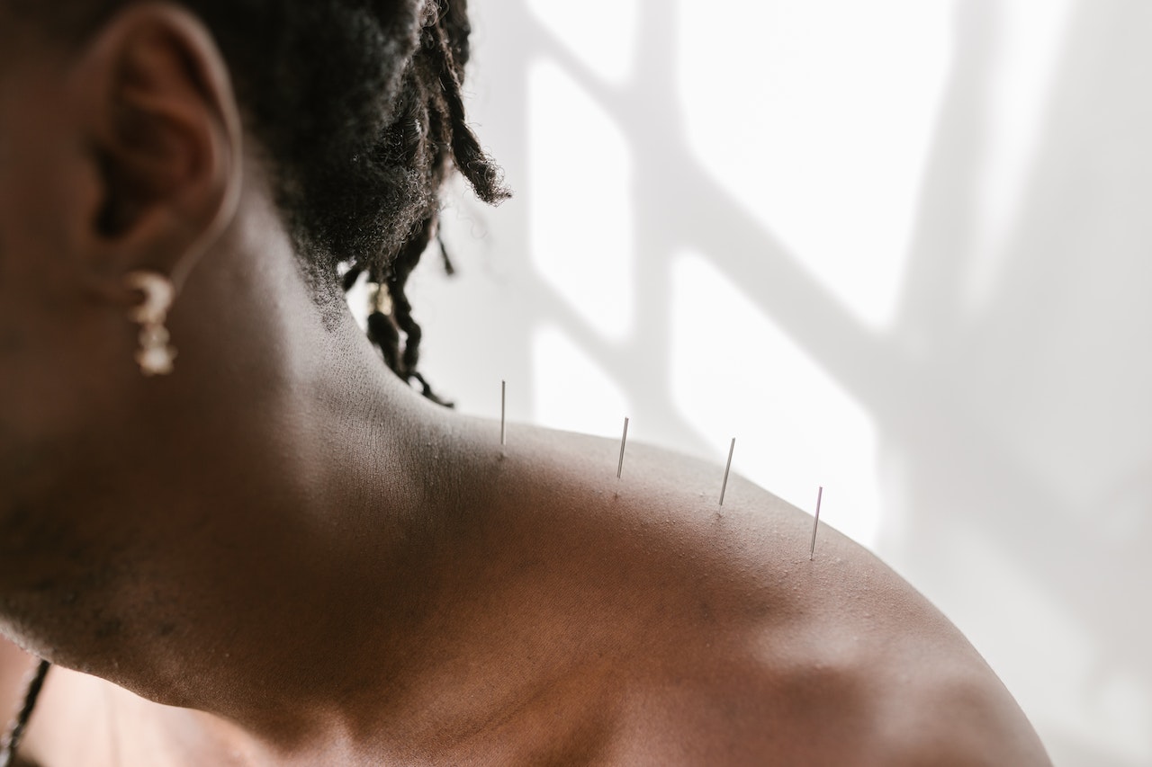 L'acupuncture est le remède naturel contre l'anxiété que vous devriez essayer