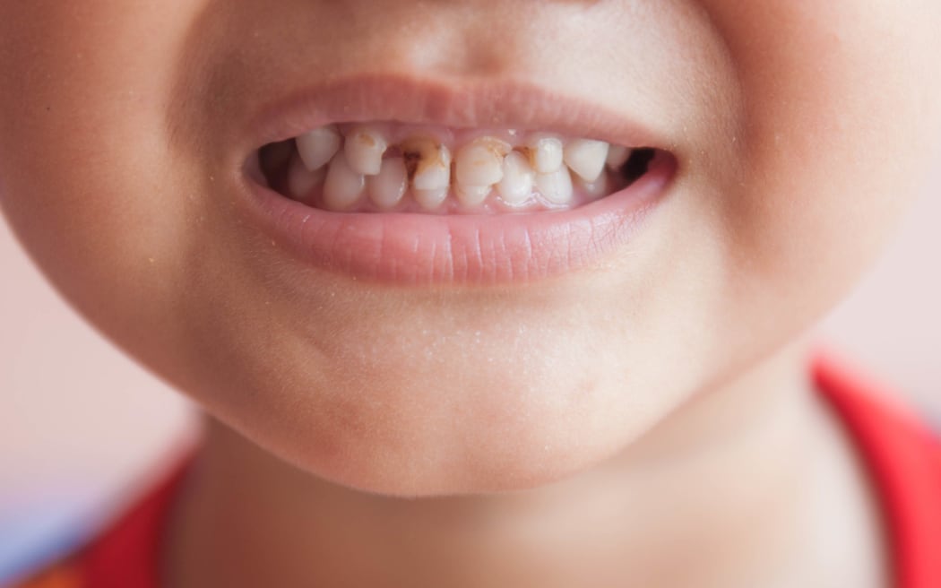 Les molaires de 2 ans : Symptômes, remèdes et tout le reste